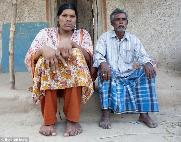 Tall tale: The 28-year-old's condition has seen her hands and feet grow abnormally large, seen here compared to her father (Photo Credit: Daily Mail)