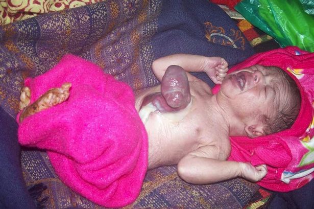 The rare heart condition affects as few as eight in a million babies (Photo Credit: Barcroft/Daily Mirror)