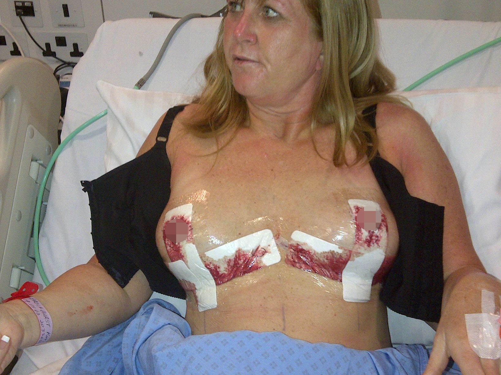 женщины с ампутированными грудями фото фото 54