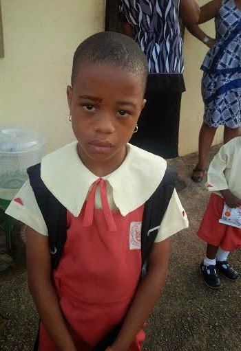 Blessing Osayande, a primary 2 pupil of South Royal School in Benin city allegedly battered by a woman believed to be her father's girlfriend. (Photo Credit: Linda Ikeji)