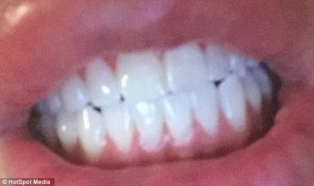Jordan James Parke's teeth