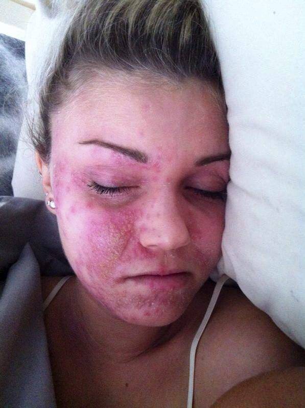 Shelley-Marie’s Eczema Became The Target For Her Mean Class Mates (Photo Credit: Metro UK)