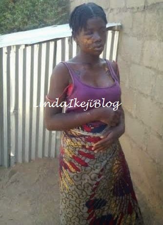 Ramatu was attacked by her elder sister with hot water after a heated argument. (Photo Credit: Linda Ikeji Blog)