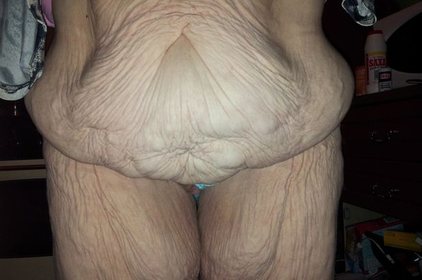 Melissa Foreman left with rolls of saggy skin after a gastric wrap operation (Photo Credit: Mirror UK)