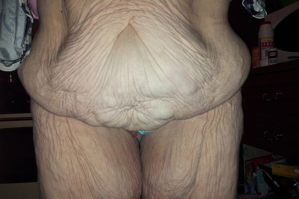 Melissa Foreman left with rolls of saggy skin after a gastric wrap operation (Photo Credit: Mirror UK)