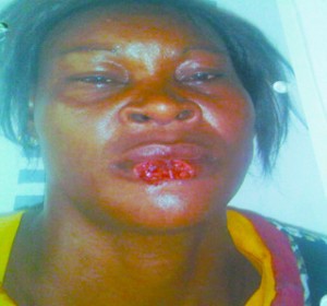 Ada Joy had part of her lower lip bitten off by her friend, Chioma Ejiofor,32, at Canal Extension, off Itanola Drive, Ajao Estate area of Lagos state over scuffle for an alleged gossip. (Photo Credit: PM News)