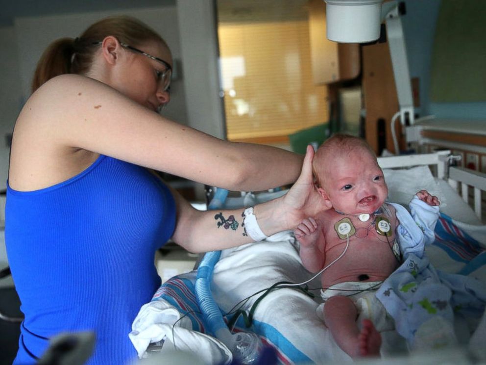 Theis baby, Eli Thompson was born on Wednesday, March 4, 2015 without a nose in Alabama and has been doing perfectly well. (Photo Credit: ABC News)