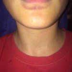 Kylie-Jenner-Lips-Gone-Wrong- The Trent