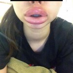 Kylie-Jenner-Lips-Gone-Wrong5-The Trent