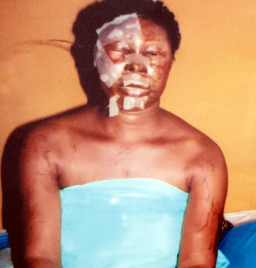 Bamidele Otakiti was attacked with an acid by some thugs sent by her ex-husband, Ajayi Olatunbosun, in her shop on Adejobi Street in the Ajasa Command area of Lagos State. (Photo Credit; Punch)