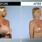 Breast implant
