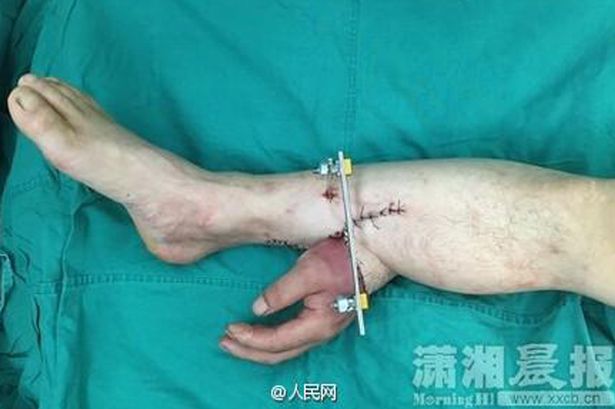 Man's severed hand was fixed to his leg to keep it alive before it was finally fixed back to the arm. (Photo Credit: (Picture: PDChina/Twitter))