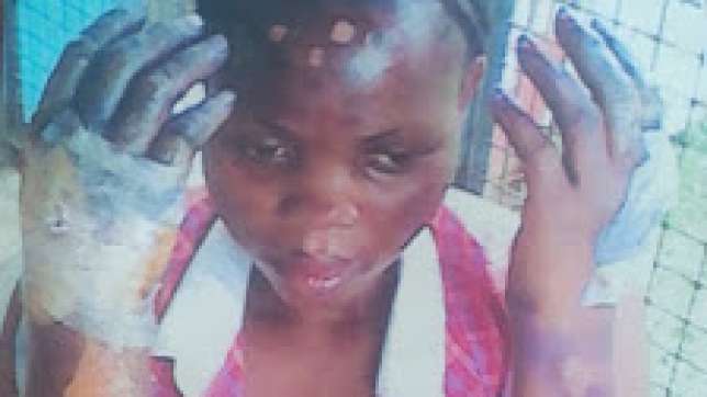 Pregnant  Stella Isaac, was set ablaze by her boyfriend, Lucky Esonahae at Uwelu Quarters in Benin on Monday, July 6, 2015.
