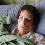 Child Victim of cluster bomb The Trent