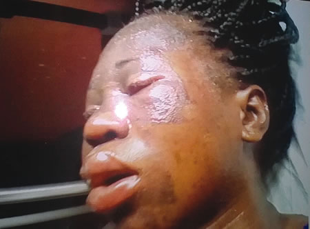 Chiwendu Nwobodo, 25, was bathed with hot oil during a faceoff with neighbour in Surulere, Lagos State | Punch