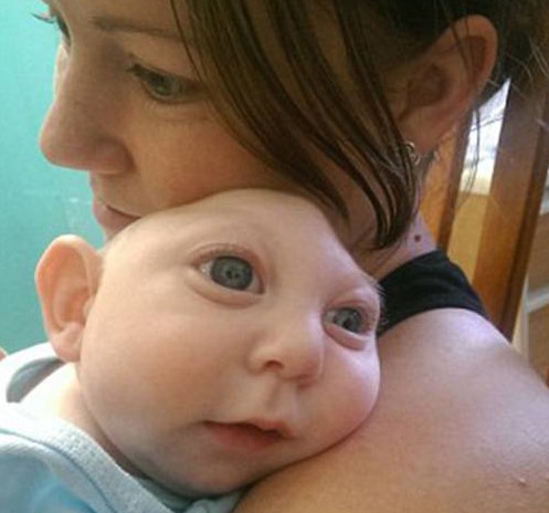 Jaxon Buell from Orlando born with half a skull | Facebook