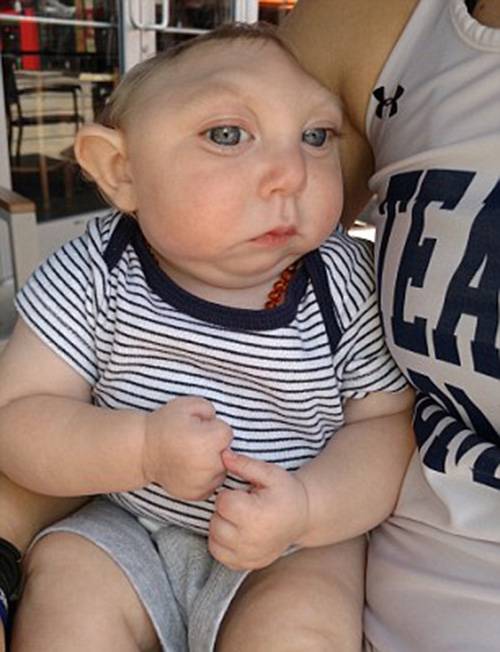 Jaxon Buell from Orlando born with half a skull | Facebook