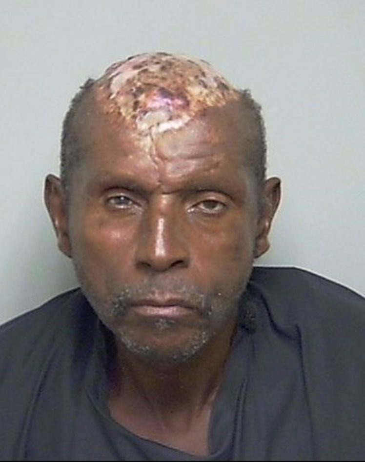 Tommie Bennett who lost his scalp to rare skin conditon was caught stealing from truck on Tuesday, September 29, 2015 in Florida | Mirror UK