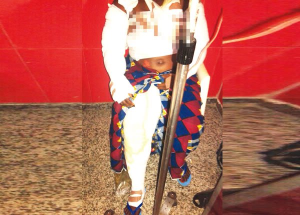 Oluwafunke Arogbonlo,32, sustained burns injuries after her sister, Yemisi poured hot waster on her at their house on Road 1, Federal Housing Estate, Mile 4, Port Harcourt, Rivers State | Punch