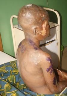 9-year-old Chinwedu Precious was scalded with hot water by her boss, Mrs. Ifeoma Mbakwe, at Alagbado area of Lagos State on Sunday, December 27, 2015 | PM News