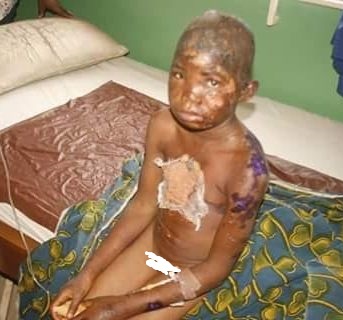 9-year-old Chinwedu Precious was scalded with hot water by her boss, Mrs. Ifeoma Mbakwe, at Alagbado area of Lagos State on Sunday, December 27, 2015 | PM News