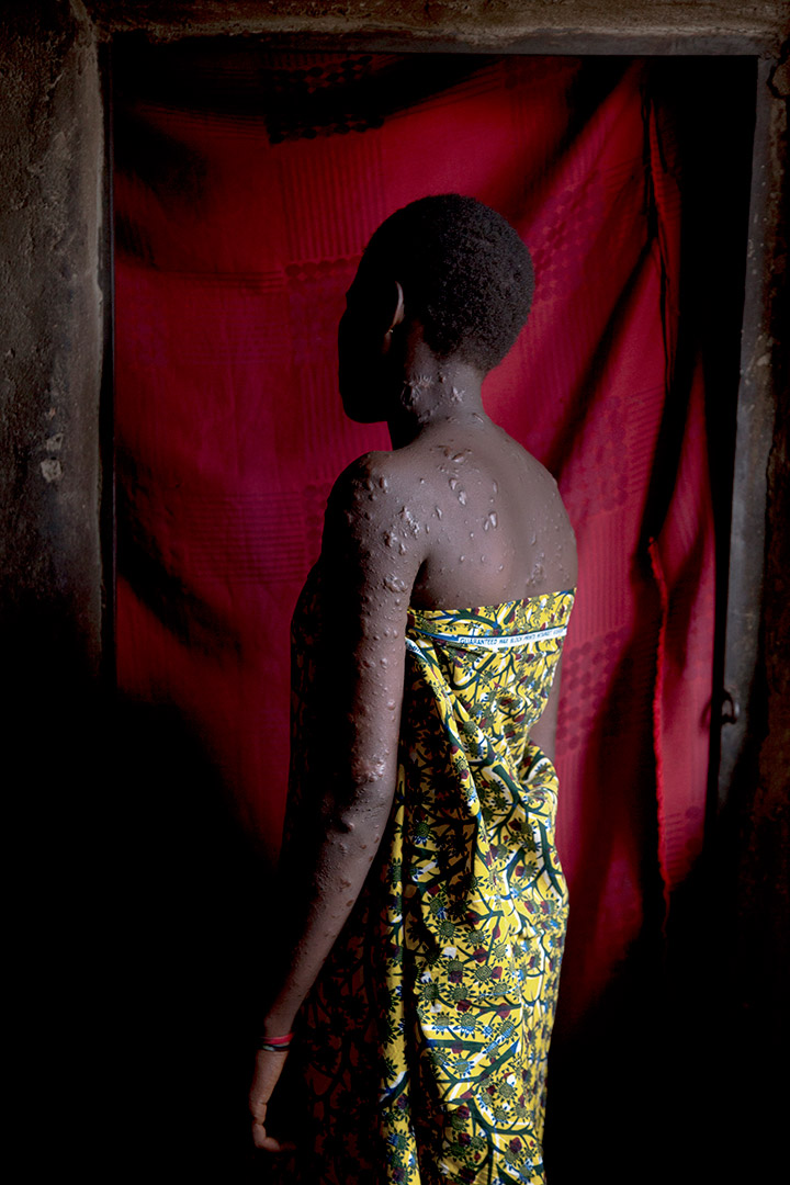 Janet Elisha Daniang, 15, is photographed in her home in Kaduna, Nigeria on April 4, 2013. Daniang bears the scars of the St. Rita Catholic church bombing that took place on October 28, 2012 in Kaduna, where 4 people died and 192 were injured. | Ed Kashi 