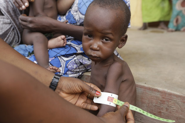 A file photo a doctor treating to a malnourished child at a refugee camp in Yola, Nigeria in 2015. | AP Photo/Sunday Alamba