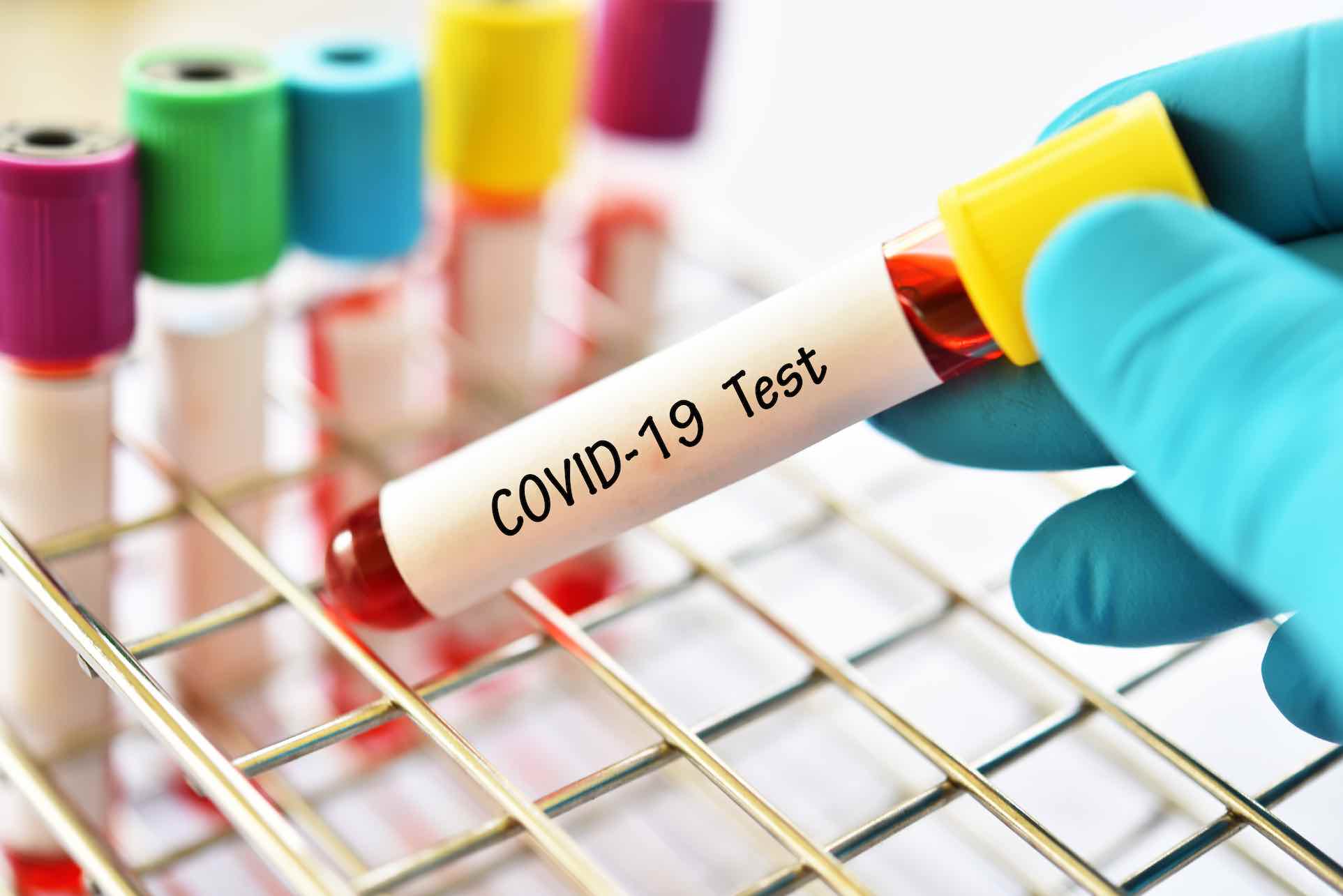 COVID-19 TEST, coronavirus