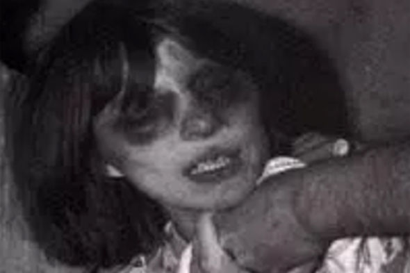 Anneliese Michel after one of he exorcism sessions