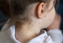 US Reports First Measles Deaths in 35 Years as 2 Die in Pennsylvania Red rash indicating measles in a child.